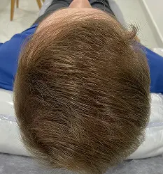 Queda masculina avançada depois